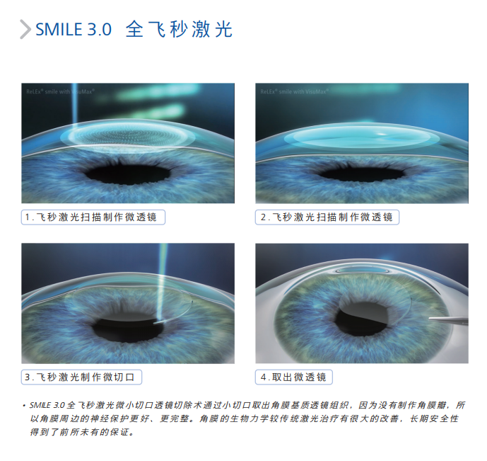 在汉中做近视手术，这几件事你一定得知道插图7