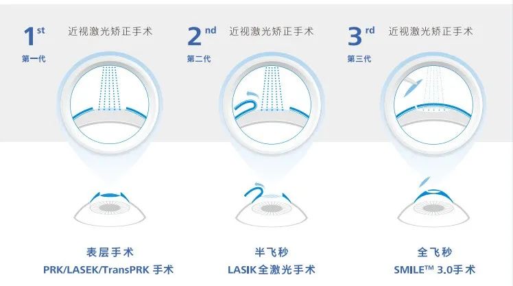 在汉中做近视手术，这几件事你一定得知道插图10